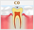 C0【ごく初期段階の虫歯】