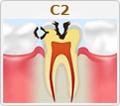 C2【象牙質の虫歯】