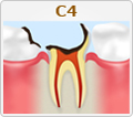 C4【歯の大部分が溶けてしまった虫歯】